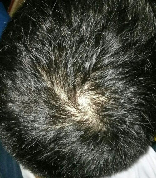 (脱发后长出绒毛能长成头发不)脱发后长出绒毛是否能长成正常头发？